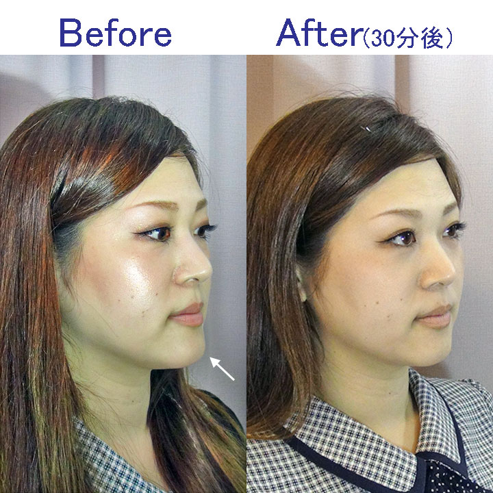 顔歪み 顎歪み症例 事例 北九州市小倉南区の美容整体 院